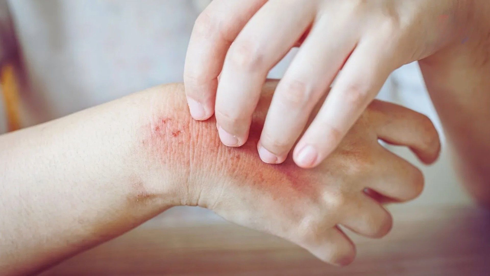 فطريّات جلديّة تنتشر… هل من داعٍ للهلع؟